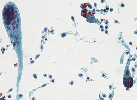 dr_swamy_comet_cells2_cytopathology_785x400.jpg