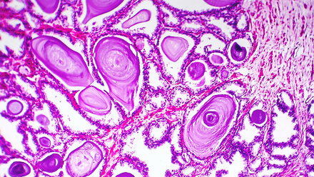 Histopatology of prostate gland hyperplasia_sm.jpg