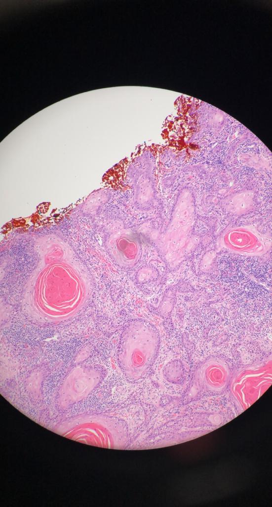 cell carcinoma