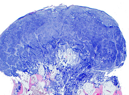kindblom_osteochondroma_mushroom_virology_785x400.jpeg.jpeg